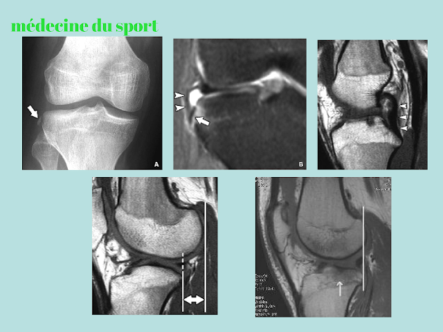 IMAGERIE DU GENOU APPLIQUÉE A LA PATHOLOGIE SPORTIVE