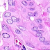 Orphan Annie Eye Nuclei : Pathology - Pathology 101 with Flashcard at University of ... / Right, an intranuclear pseudoinclusion is present in the large oval nucleus.