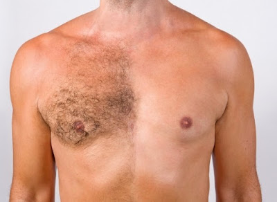 How to remove chest hair permanently