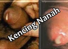 Jual Obat Kencing Nanah Gonore Hingga Ke Jakarta