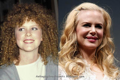 Nicole Kidman lip augmentation injection