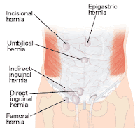 Cara Mengobati Hernia