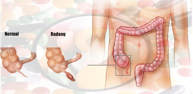 Pengobatan Penyakit Usus Buntu