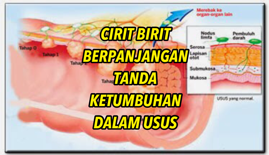 Cirit Birit Berpanjangan Rupanya Tanda Ketumbuhan Dalam Usus