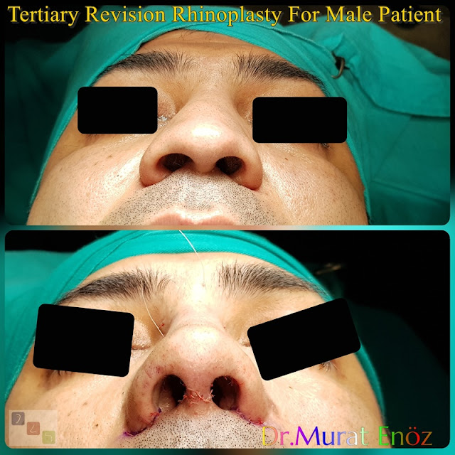 Tertiary Revision Rhinoplasty For Male Patient - Alar Base Resection - 3rd Revision Nose Job With Cadaveric Rib Cartilage - Revision Nose Aesthetic Doctor in Istanbul