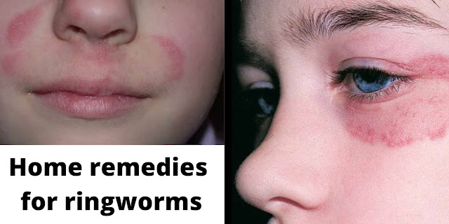 Home remedies for ringworms 2021