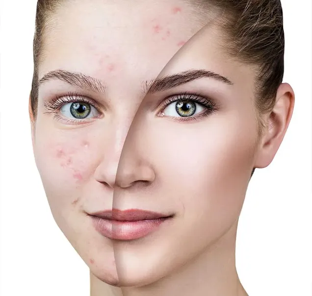 Where To Get Trustworthy Acne Treatment