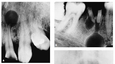 CYSTS OF THE JAWS AND BENIGN ODONTOGENIC TUMORS Cysts of the Jaw