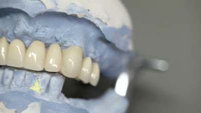  Quy trình làm cầu răng sứ tại nha khoa