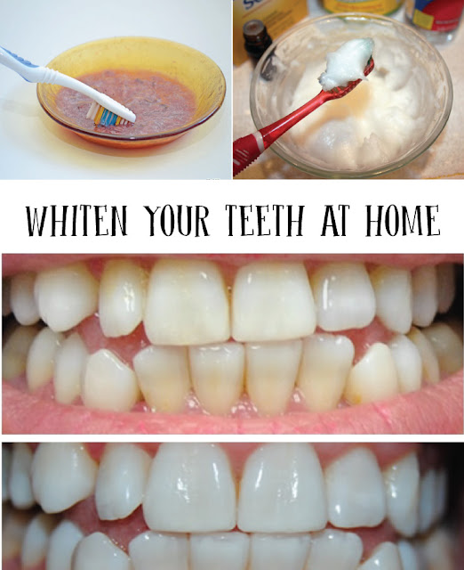 WHITEN YOUR TEETH AT HOME – Tips for a Beautiful Smile All Remedies