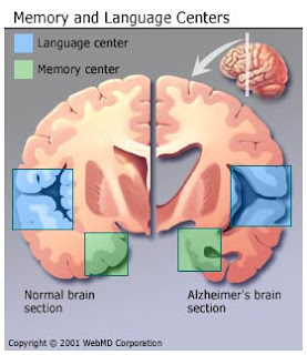 alzheimers diseas