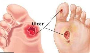 Diabetic Foot Conditions