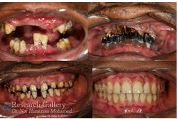 7 Penyakit Berbahaya Pada Gigi Yang Banyak Tidak Menyadarinya