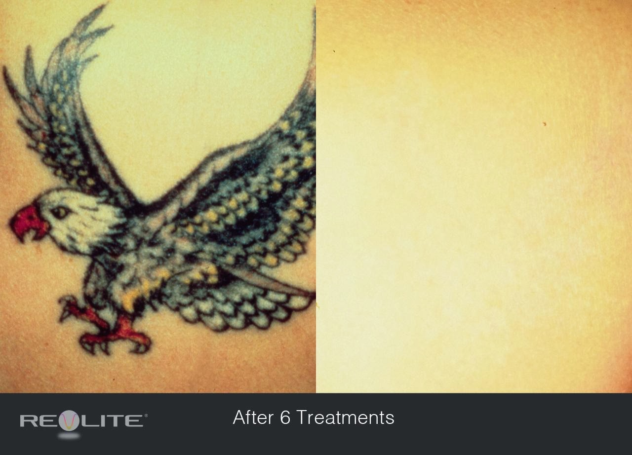 Remover tatuagem com Laser antes e depois preço