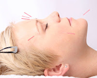 Getting relief from acupuncture treatment