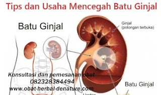 cara menghancurkan batu ginjal tanpa operasi,obat batu ginjal,obat kencing batu,cara mengeluarkan batu ginjal tanpa operasi,cara menghilangkan batu ginjal tanpa operasi