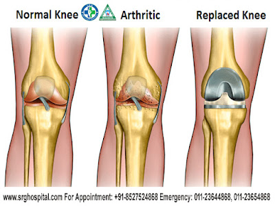 Knee Replacement in Shastri Nagar