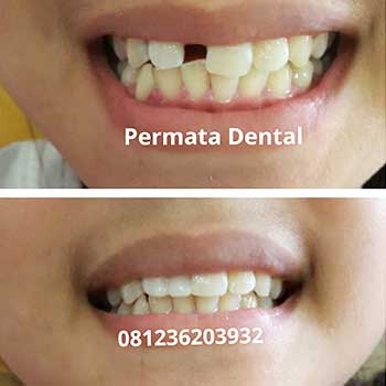 Ahli Gigi  Bali Permata Dental Gigi  Palsu Lepas Pasang 