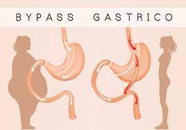 Gastric Bypass Surgery in Delhi