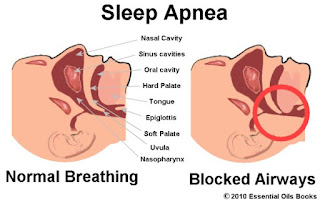 Sleep apnea propersleep.blogspot