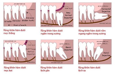 Vì sao nên nhổ răng khôn?