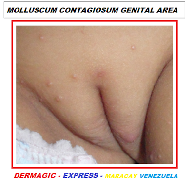 Mollusum contagiosum genital area little girl