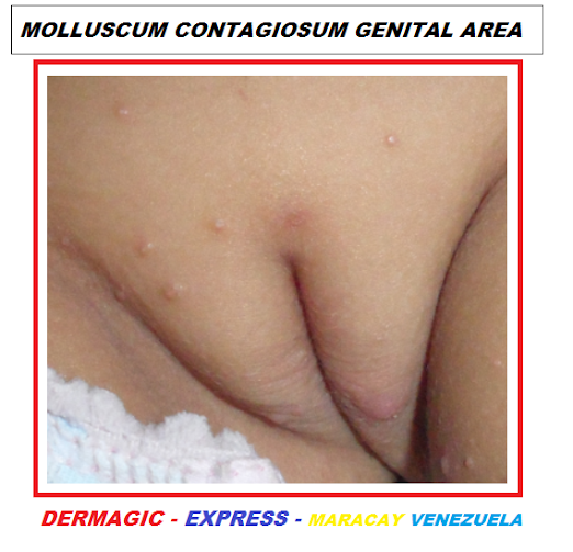 Molusco contagioso área genital niña