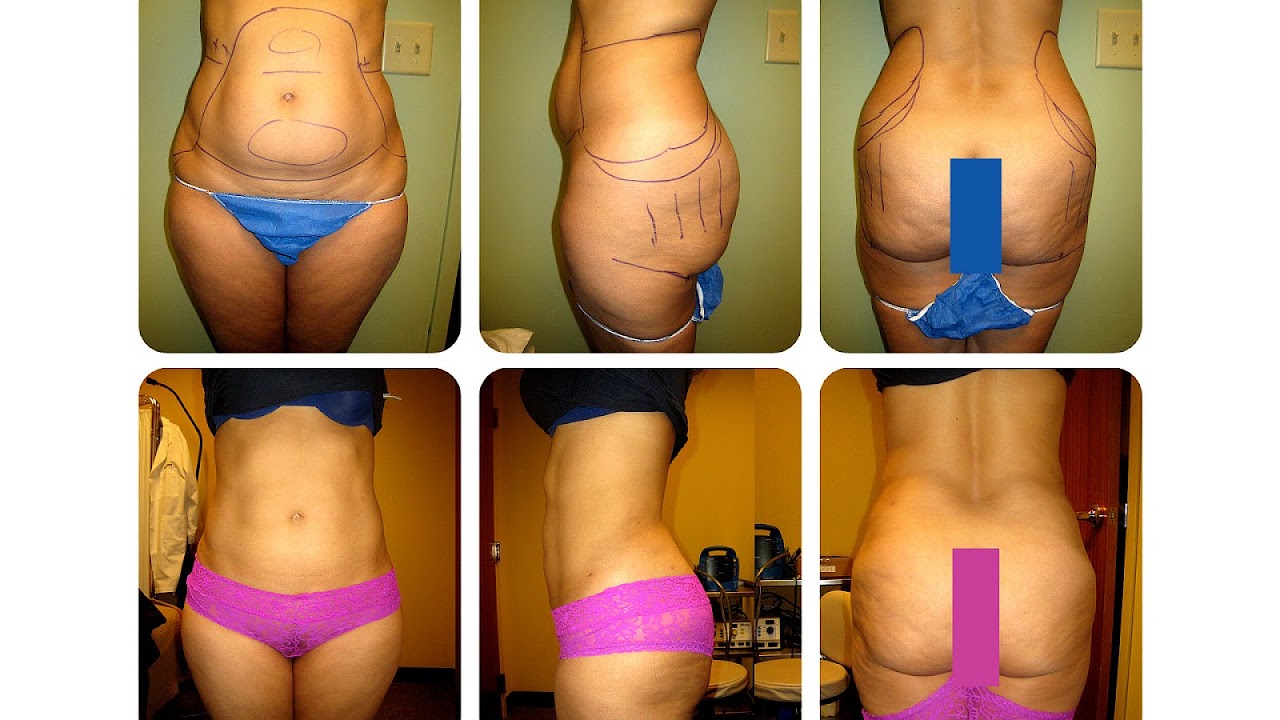 Full Body Lift Before And After Photos