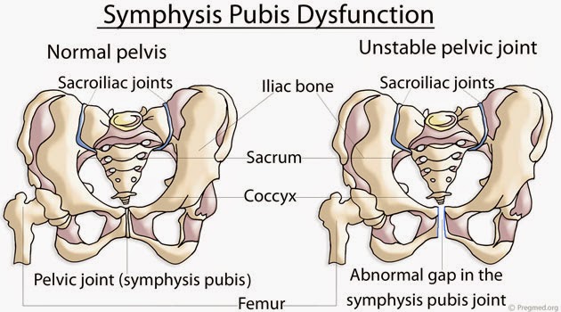 Puteriku Sayang.com: Symphysis Pubis Dysfunction ( SPD )