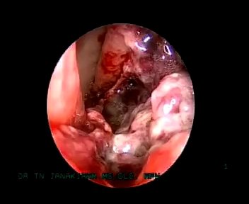 Ubat Penawar Resdung: Apa itu Resdung (Sinus)?