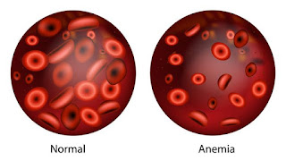 Mencegah Penyakit Anemia