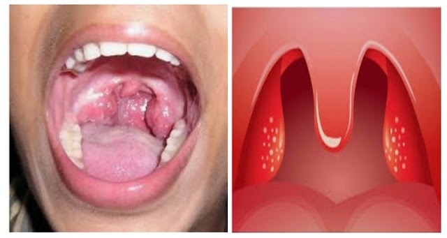 Tonsillitis: Causes, Symptoms and Treatment.