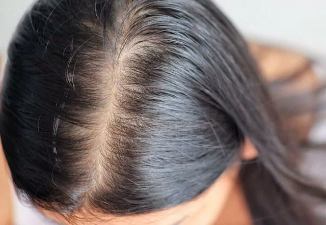 La Pérdida De Cabello En Las Mujeres: La Alopecia Androgenética