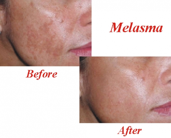 Melasma Cream