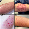 What Is The Best Tattoo Removal Cream - Tattoo Removal Clinics Bristol - Benjamin Roberts - Trichloroacetic acid (tca) is a powerful acid that can be used to remove the upper layers of skin.
