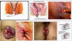 hemorrhoids hemorroid hemoroid ambeyen