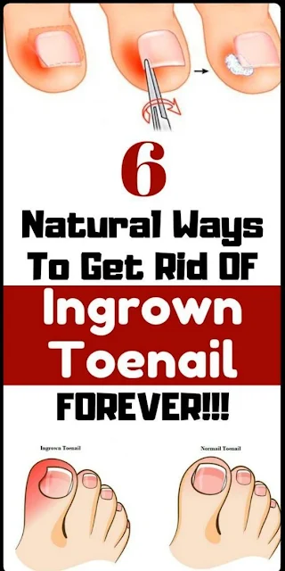 6 Effective Home Remedies to Get Rid of an Ingrown Toenail