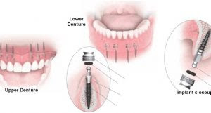 Quy trình Implant khi mất nhiều răng