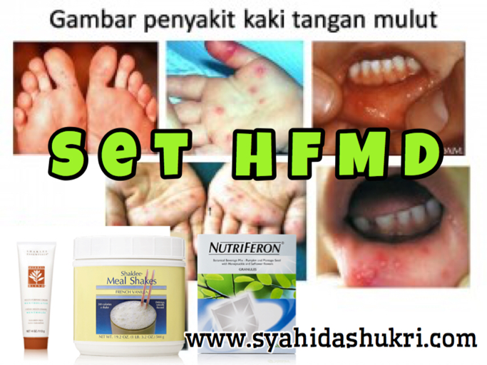 Tips Merawat Penyakit Tangan Kaki Mulut HFMD • SyahidaShukri