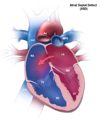 Defek Septum Atrium