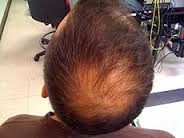 Hair Loss Treatment,