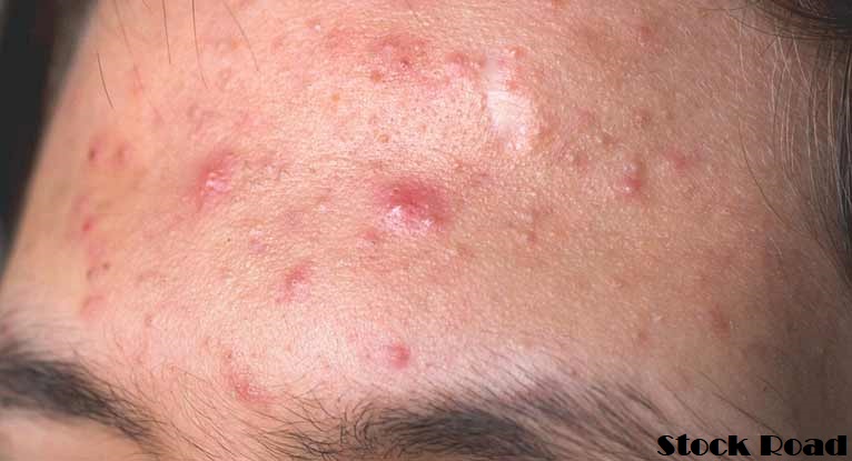 पिंपल्स का शरीर पर असर: इन गलतियों के कारण चेहरे पर आते हैं मुंहासे ,बदलें कुछ आदतें (Effect of pimples on the body: Due to these mistakes, acne comes on the face, change some habits)