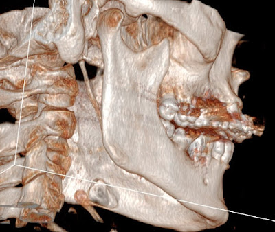 Reconstrucción 3D de cavidad de Stafner