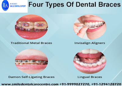 Orthodontic Dental Clinic offer Dental Braces Treatment And Best Invisible Aligner Treatment in Faridabad