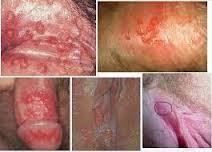 http://solusi-obat-herbal.blogspot.com/2016/08/pengobatan-penyakit-herpes-simpleks.html