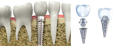 Cấu tạo của răng implant gồm những gì?