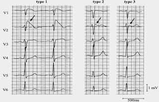   ekg คือ, ekg ผิดปกติ, ekg 12 lead ปกติ, normal sinus rhythm คือ, basic ekg, p wave คือ, การติด ekg monitor, กราฟคลื่นหัวใจผิดปกติ, ekg ย่อมาจาก