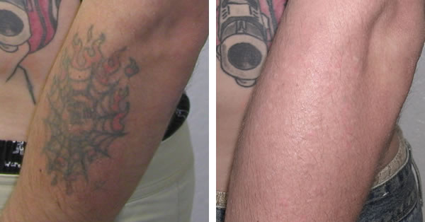 Laser Tattoo Removal Before and After Pictures | Tattoo Removal ...