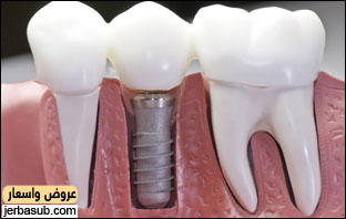 زراعة اسنان مجانا في الرياض