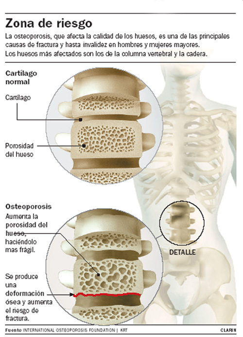 La silenciosa enfermedad de la osteoporosis